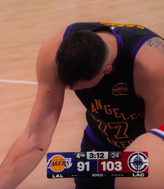 谁抓的~东契奇罚球时看向手臂 好几道伤口&amp;血迹斑斑